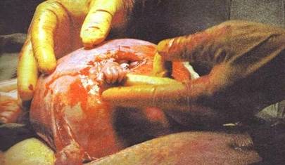Pendant que le Dr. Bruner opérait, le bébé a sorti par l'incision. sa main minuscule, mais entièrement développée, et a Fermement saisi le doigt du chirurgien. Pendant que le Dr. Bruner opérait, le bébé a sorti par l'incision. sa main minuscule, mais entièrement développée, et a Fermement saisi le doigt du chirurgien.