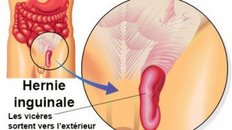La Hernie Inguinale Conseils Sante Dz