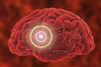Migraines : nouvelles études, nouvelles perspectives de guérison...