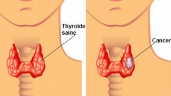 Quelle imagerie recommander dans la recherche de métastases dans le cancer médullaire de la thyroïde
