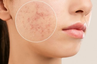 Traiter les cicatrices d'acné - Conseils - Sante-dz