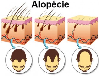Alopécie