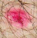 Lésion localisée due à un eczéma qui a été gratté