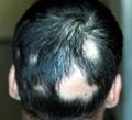 Pelade : chute de cheveux sur une zone délimitée