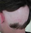 La pelade : alopécie en plaques