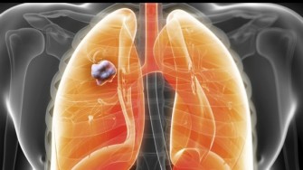 Cancer du poumon : Les thérapies ciblées en action