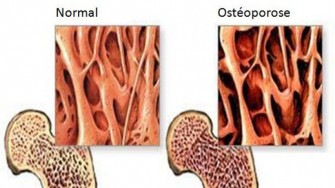 Ostéoporose et perte de masse osseuse
