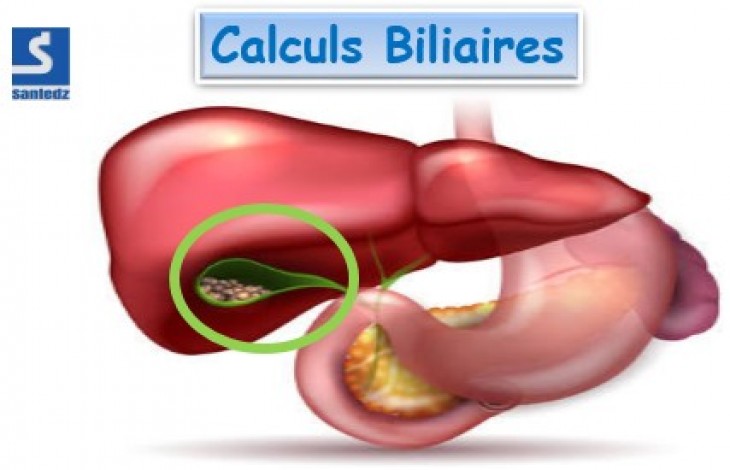 Calculs biliaires - Actualités - Sante-dz