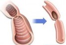 Occlusion intestinale